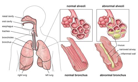 This is a picture of some alveoli and bronchus that are located in your lungs. It shows how they ...