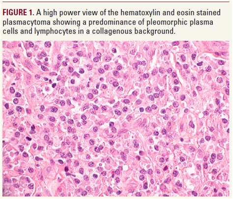 solitary plasmacytoma - pictures, photos