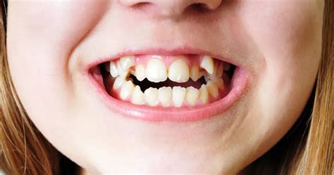 Open Bite Symptoms and Treatments: Braces, Veneers & More - Dentaly.org