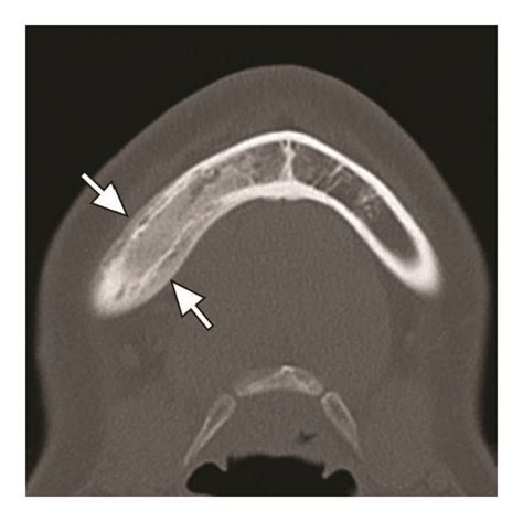 CT scan of the mandible. Axial (a) and coronal (b) and oblique sagittal ...