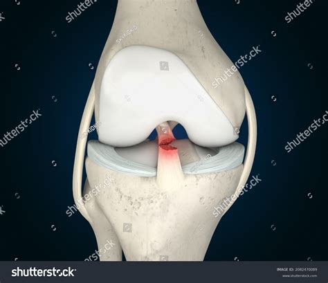 212 Acl tear Images, Stock Photos & Vectors | Shutterstock