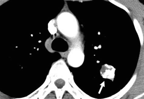 Pulmonary nodule CT - wikidoc