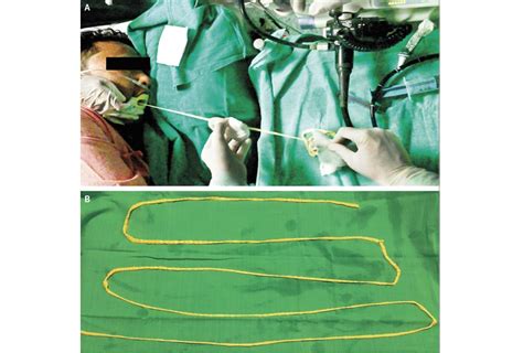 Doctors Remove 6-Foot-Long Tapeworm from Man's Gut | Live Science