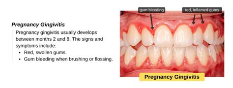 Pregnancy Gingivitis: Treat Swollen Gums during Pregnancy