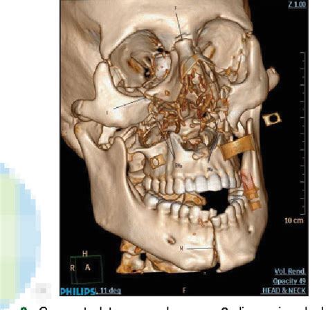 Figure 2 from Airway management in a patient with Le Fort III Fracture ...