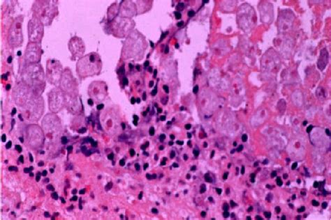 Figure 2 from Cytology and Histology The Slipshod Stooge-Amoebic Colitis | Semantic Scholar