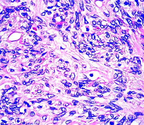 Solitary Fibrous Tumor Pathology Outlines - calorie