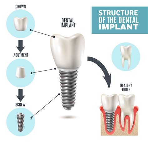 Dental Implants, Zen Clinic, Tollgate, Colchester, Essex