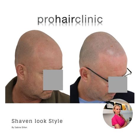 Completely bald and yet 'a full head of hair'? Yes, these people chose ...