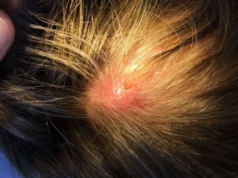 Bumps on a UK Woman's Scalp Turned Out to Be Botfly Larvae | RealClearScience