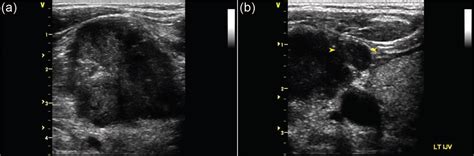 External Jugular Vein Ultrasound