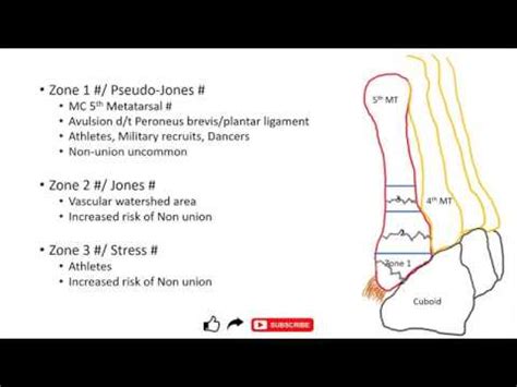 Jones fracture and Pseudo-Jones fracture ; differences - YouTube