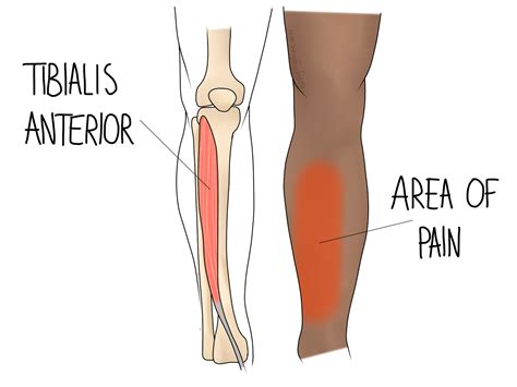 Shin Splints - Gemini Osteopathy