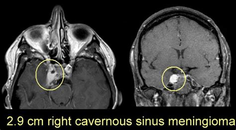 cavernous sinus meningiomas and gamma knife