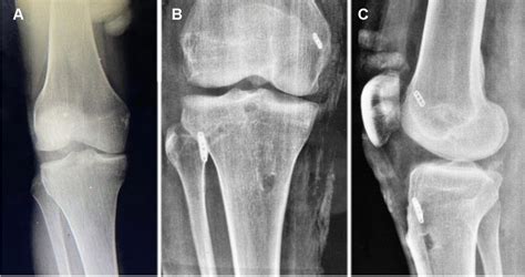 A Preoperative varus-stress radiograph of a patient with an acute... | Download Scientific Diagram