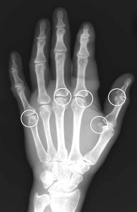 In one subject, the sesamoid bones were found at thumb IPJ and all... | Download Scientific Diagram