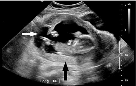 Ruptured Ectopic Pregnancy Ultrasound