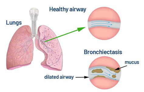 Bronchiectasis - Saint John’s Cancer Institute