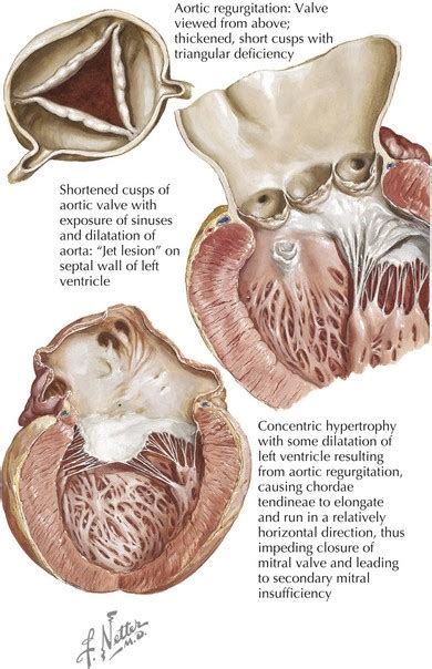 Aortic Regurgitation | Thoracic Key