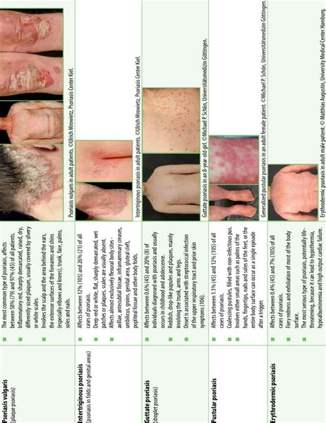 Common types of psoriasis and their manifestations | Download Scientific Diagram