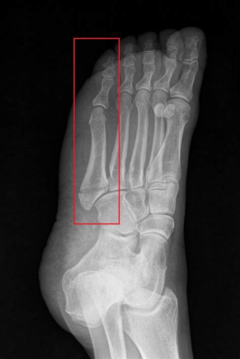 5th Metatarsal Bone Pain