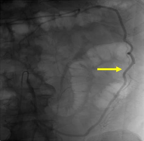 Inferior-mesenteric-artery-angiogram - Vascular Medicine - Angiologist