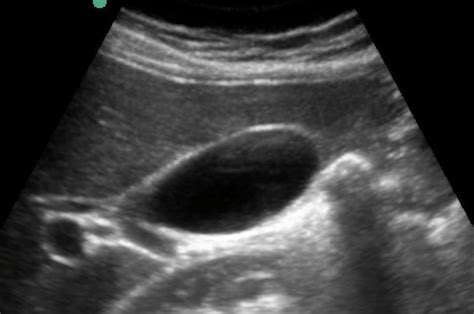 Gallbladder Anatomy Ultrasound