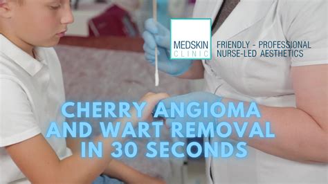 Cherry Angioma Home Remedy vs Cryotherapy Private Clinic