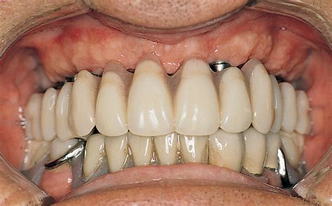 3: Implants for the maxillary edentulous patient | Pocket Dentistry