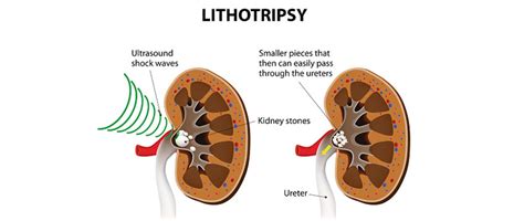 Lithotripsy: Meaning, Procedure and Benefits| Best Treatment for Kidney Stone