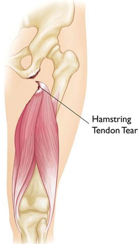 Hamstring Injury - Causes, Symptoms, Recovery Time & Treatment