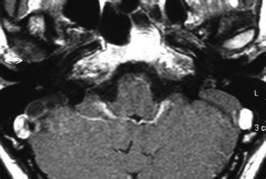 Bilaterally enlarged vestibular aqueduct - temporal bone MRI - axial... | Download Scientific ...