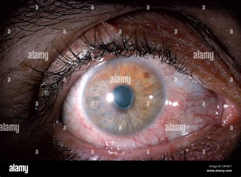 IRIDOCYCLITIS Stock Photo - Alamy