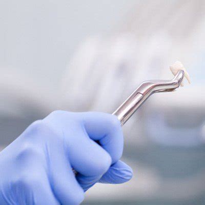 Tooth Extraction Cost UAE 2