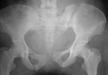 Ilium Fractures - Trauma - Orthobullets