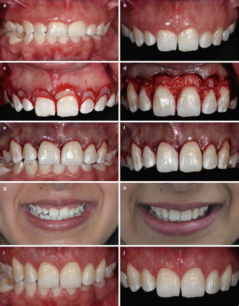 Esthetical Clinical Crown Lengthening, Lip Repositioning, and Gingival Depigmentation | Pocket ...