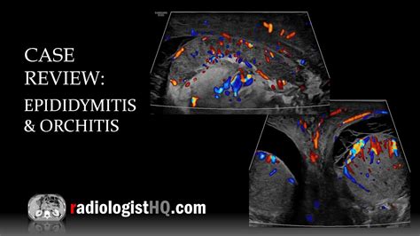 Ultrasound of Epididymitis & Orchitis - YouTube