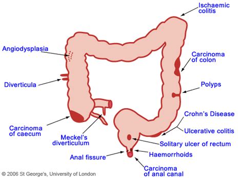 Gastrointestinal Bleeding