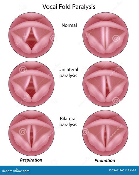Vocal cord paralysis stock vector. Illustration of medical - 27641160