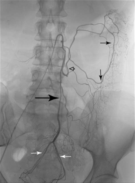 Superior Mesenteric Artery Angiogram