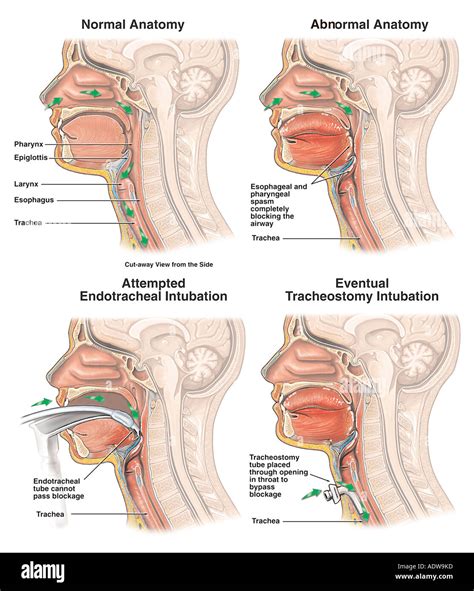 Tracheostomy hi-res stock photography and images - Alamy