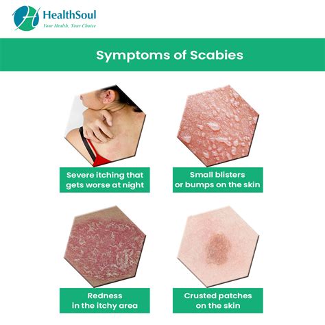 Scabies: Diagnosis & Treatment – Healthsoul