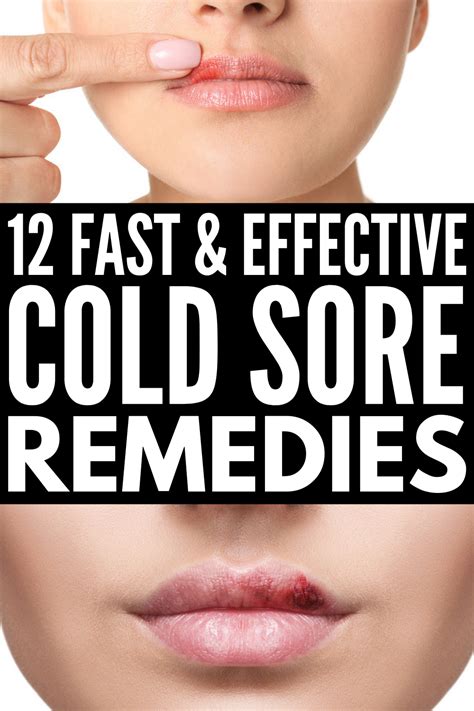 Remedies for cold sores – Artofit