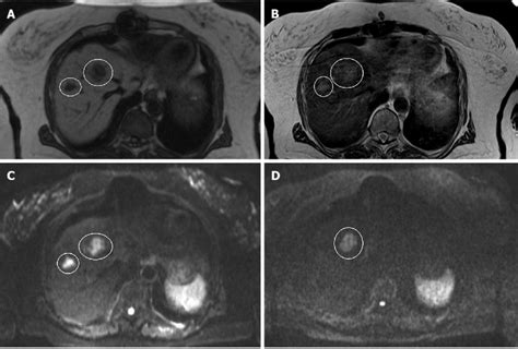 MRI and DWI of hepatic metastases. A: T1-weighted; B: T2-weighted; C:... | Download Scientific ...