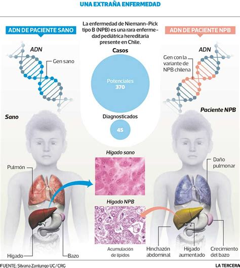 Enfermedad de Niemann-Pick tipo B | FEMEXER