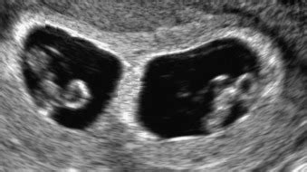 Dichorionic Diamniotic Twin Gestations | Radiology Key