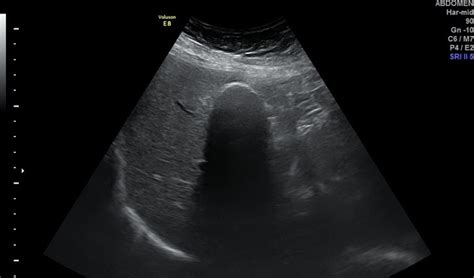 Porcelain Gallbladder Ultrasound