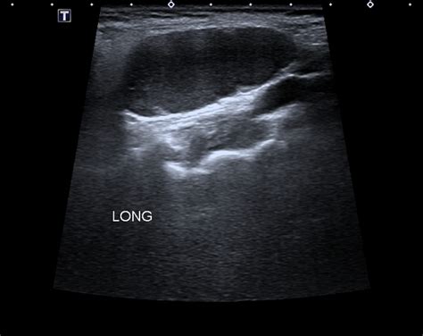 Branchial Cleft Cyst Ultrasound