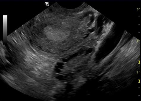 Polycystic Ovary Syndrome - PCOS - Fertility - Ultrasound - TeachMeObGyn