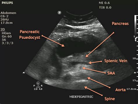 Pancreatic Pseudocyst Ultrasound